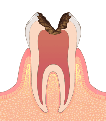 神経に到達したむし歯