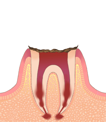 末期のむし歯