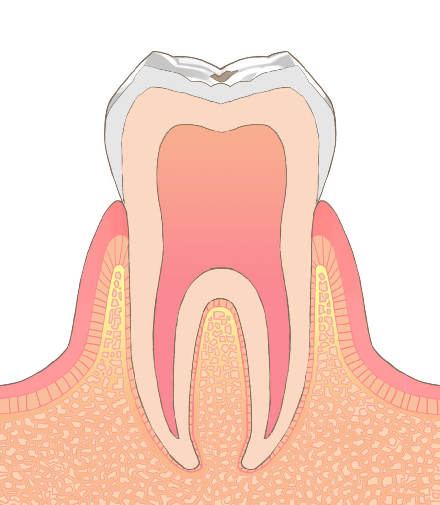 初期のむし歯